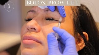 Botox Brow Lift [upl. by Eceinwahs]