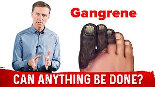 Diabetic Gangrene Symptoms Causes amp Treatment – DrBerg On Diabetic Foot [upl. by Elocin75]