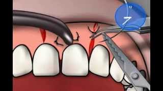 Vicryl Suture Material [upl. by Aggi]