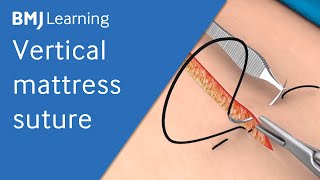 Vertical Mattress Suture  BMJ Learning [upl. by Odnumyer]