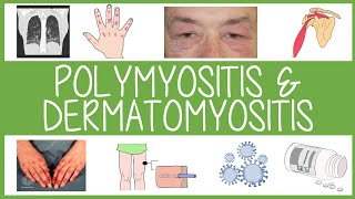 Focus on Dermatomyositis Floranne Ernste MD Rheumatologist [upl. by Ditzel]