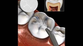 Conservative  Minimally Invasive Technique for removal dental caries [upl. by Nenad521]