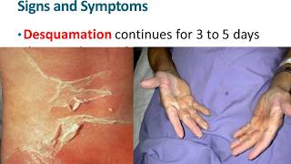 Dermatologic emergencies 1 Staphylococcal Scalded Skin Syndrome [upl. by Troth]