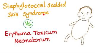 Staphylococcal Scalded Skin Syndrome VS Erythema Toxicum Neonatorum [upl. by Ailec234]