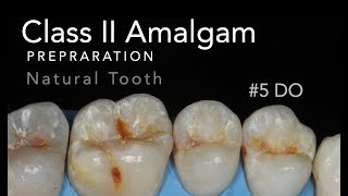 Class II Amalgam Preparation  5 DO Natural Tooth [upl. by Giah]