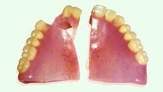 How to Repair a Broken Denture in 25 Minutes [upl. by Inar]