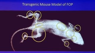 Genetic Mysteries FOP  When Bodies Turn to Bone [upl. by Ozzy]