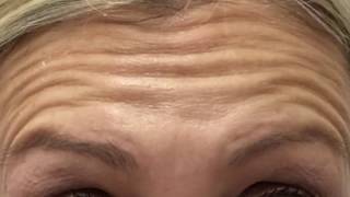 Botox forehead before and after [upl. by Prudy]