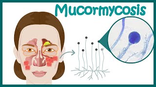 Mucormycosis The black fungus maiming Covid patients in India [upl. by Yderf]