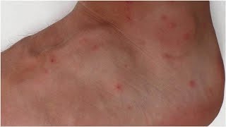 How to Identify and Treat Mite Bites  Tita TV [upl. by Anaujait74]