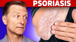 Psoriasis Treatment – The Best 3 Remedies for Psoriasis – DrBerg [upl. by Notgnilra]