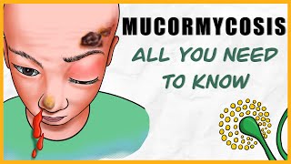 Mucormycosis microbiology types signs amp symptoms diagnosis treatment [upl. by Larok]