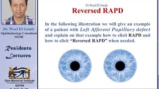 Reversed RAPD explained [upl. by Palm]