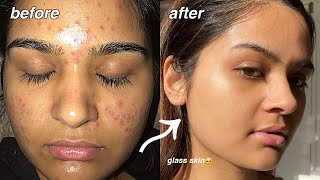 how i cleared my acne FOR GOOD something finally worked [upl. by Alius]