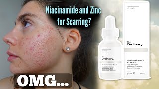 why the ordinary niacinamide 10  zinc 1 is causing purging and breakouts 😅 [upl. by Luba493]