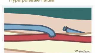 Physical Examination of Arteriovenous Fistula [upl. by Kati985]