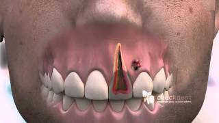 How to treat a dental Fistula [upl. by Ynnod681]