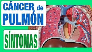 Cáncer de Pulmón  Síntomas [upl. by Jarrett]