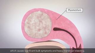 Diagnostic Hystroscopy before IVF [upl. by Terrell639]