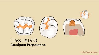 Class I Amalgam Preparation  My Dental Key [upl. by Legnaesoj347]