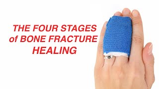 The Four Stages of Bone Fracture Healing [upl. by Aynwad]