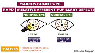 Abnormal Pupillary Reflexes  Ophthalmology [upl. by Snoddy538]