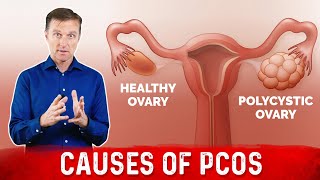 3 Causes of Polycystic Ovarian Syndrome PCOS amp High Androgens – Dr Berg [upl. by Salot]