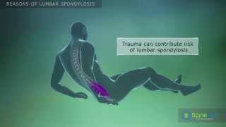 Lumbar Spondylosis Reasons [upl. by Brezin]