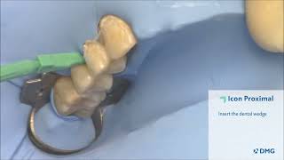 Icon Proximal  Caries Infiltration StepByStep with Dr Augusto Robles [upl. by Anivad]