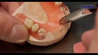 Thermoplastic dentures  Repair and service [upl. by Ahearn]