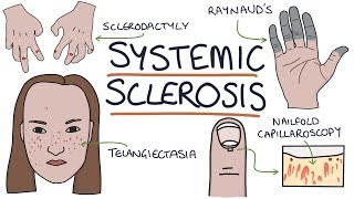 Systemic Sclerosis and Scleroderma Visual Explanation for Students [upl. by Redvers]