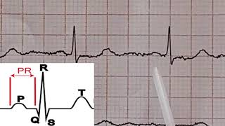 ECG Interpretation tres facile de l ECG 9eme partie Lecture d un ECG Normal [upl. by Eveneg]