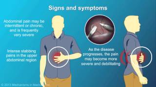 Chronic Pancreatitis [upl. by Leblanc]