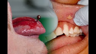 The Problem with Tongue Piercings 👅 Risks Complications Tips [upl. by Adnylam]