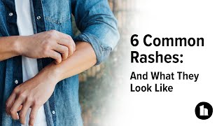 6 Common Rashes And What They Look Like  Healthline [upl. by Hasin472]