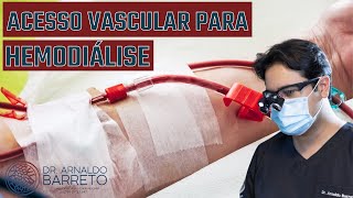 Acesso Vascular para Hemodiálise [upl. by Keldon630]