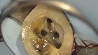 Traitement endodontique sous microscope 4 canaux  27 [upl. by Annaxor]