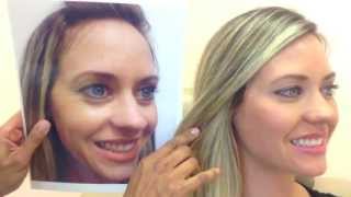 Botox amp Restylane Before amp After [upl. by Adniled]