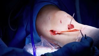 MCL Reconstruction Surgery [upl. by Mines]