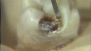 Removal of Carious Lesion [upl. by Fazeli]