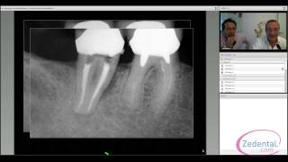 La chirurgie endodontique  le choix de la conservation [upl. by Hassin]